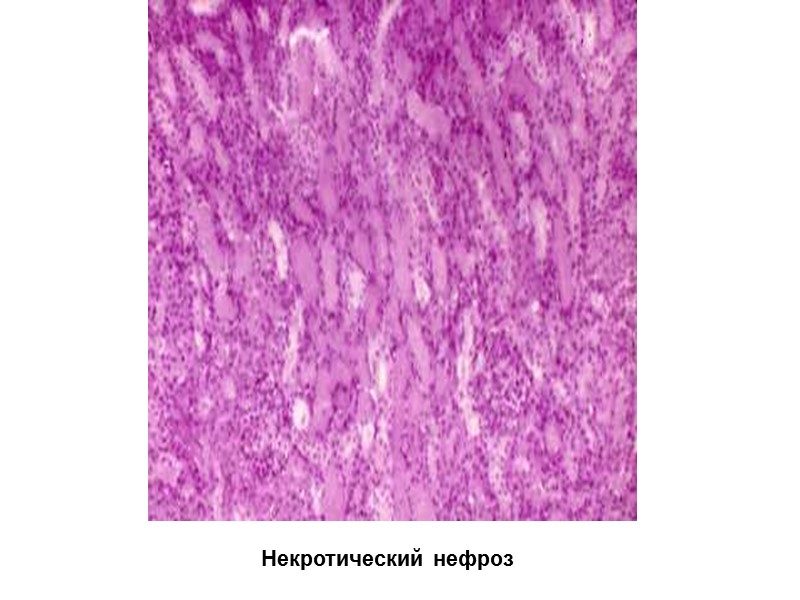 Некротический нефроз